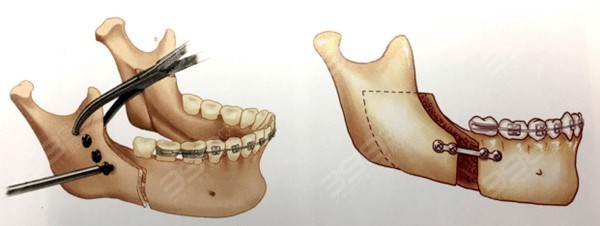 正颌手术固定