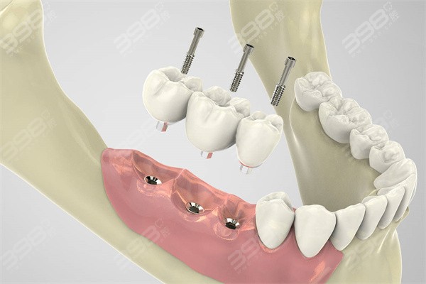 多颗种植牙
