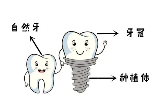 广州牙科医院种植牙多少钱一颗