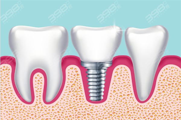 合肥种植牙医院排名：在合肥种植牙哪家口腔医院好又便宜