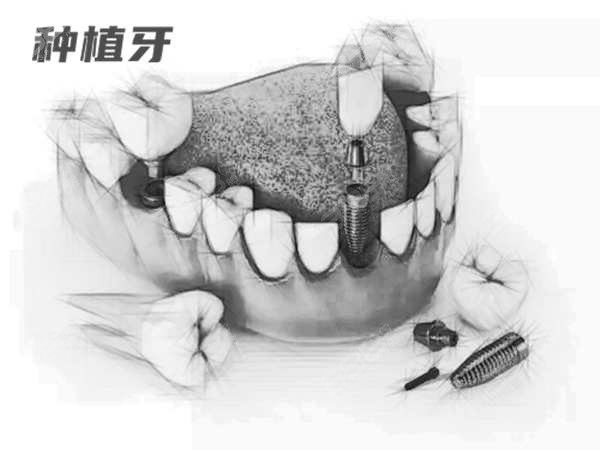 杭州植牙技术哪家医院好？杭州种植牙口碑好价格实惠的医院盘点