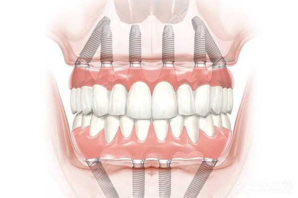 全口种植牙方案