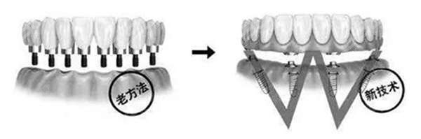 金华半口/全口种植牙收费标准