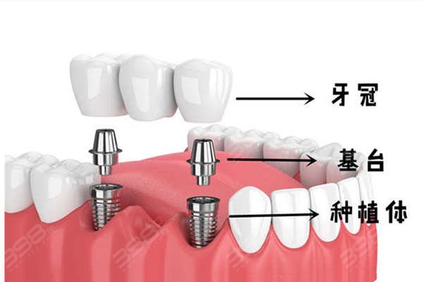 清远种植牙哪家医院好