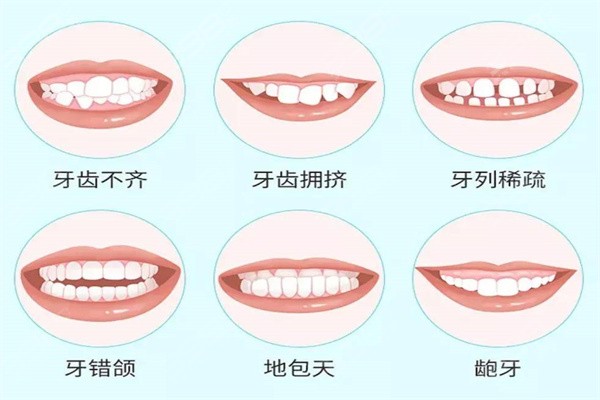 毕节矫正牙齿需要多少钱