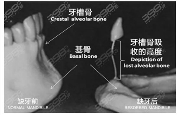 清远种牙要多少钱1颗？看清远种植牙单颗/半口/全口收费标准