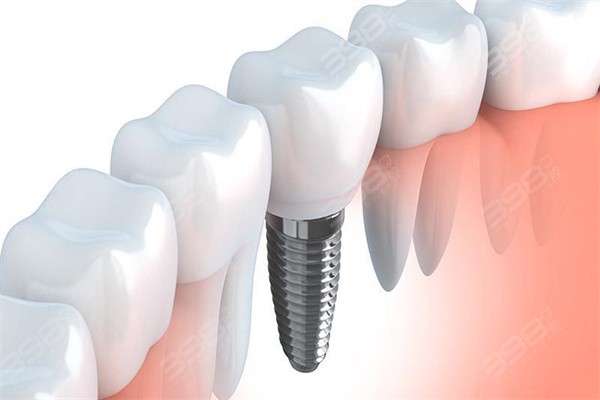 2024优诺口腔种植牙价格查询：青岛/哈尔滨/潍坊种植牙收费挺实惠
