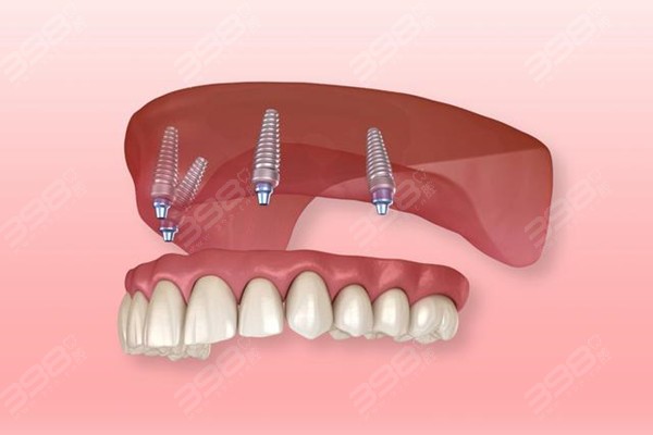南宁全口种植牙需要多少钱?南宁柏乐/诺贝尔/蓝天口腔半全口种牙16800起