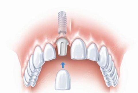 种植牙门牙