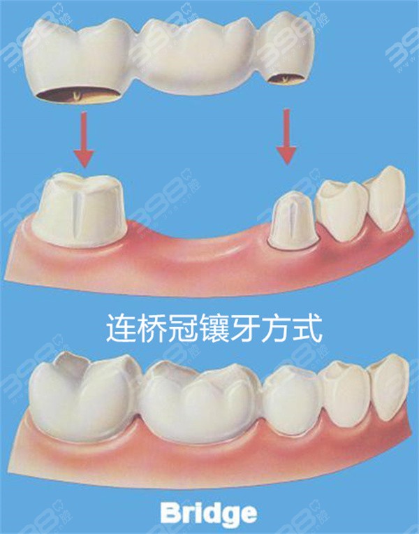 连桥冠