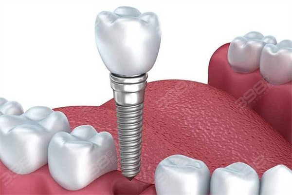 武汉大众口腔种植牙价格