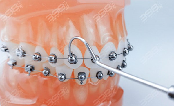 贝壳口腔医院牙齿矫正价格表