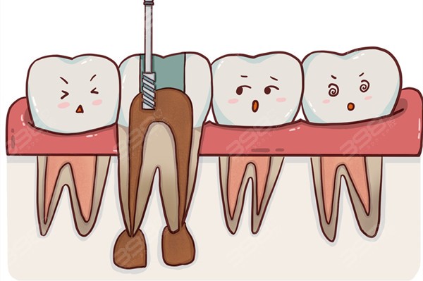 奉贤区根管治疗多少钱一颗？