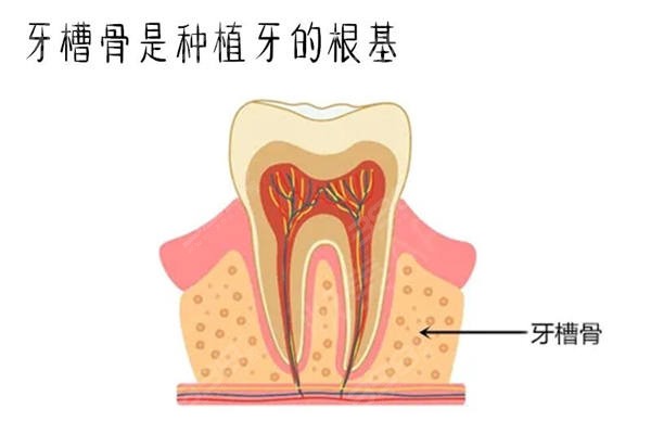 珠海海精灵齿科种植牙价格表