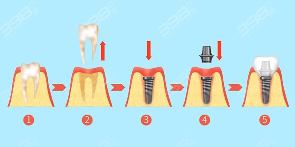 极简种植牙的步骤