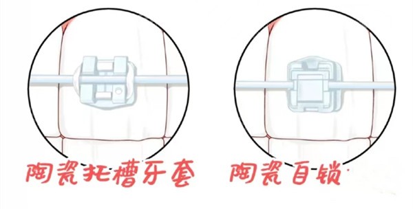 湘西陶瓷半隐形托槽矫正多少钱？