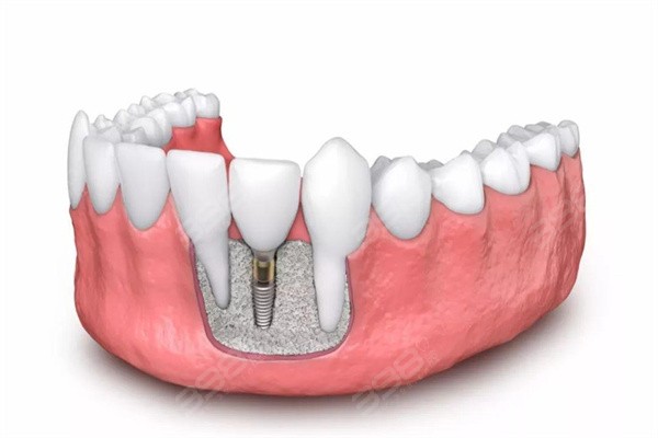 了解泉州种植牙多少钱一颗？先看泉州靠谱的口腔医院种牙价格