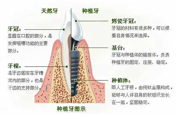 义乌种植牙口腔医院哪家好