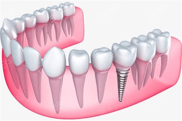 沈阳种植牙哪家医院好