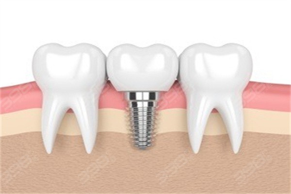 泉州进口种植牙价格