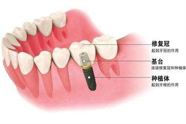 北京爵冠口腔种植牙多少钱