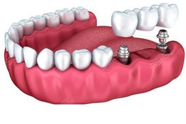 厦门种植牙哪家医院好
