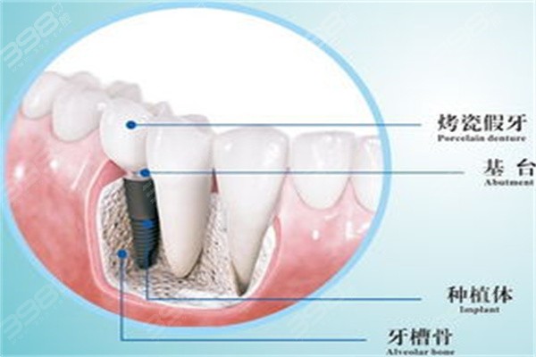 根管治疗