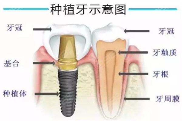 种植牙