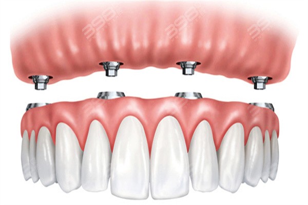 武汉全口种植牙价格
