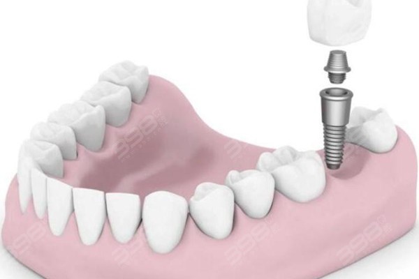 上海口腔医院种植牙排名榜:前十有鼎植/雅悦/松丰/英博/博厚口腔种牙收费低