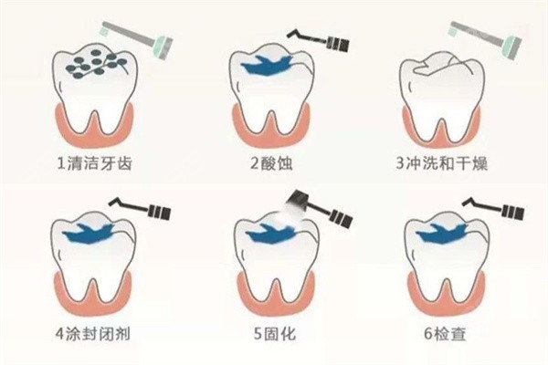 小白兔口腔医院儿牙治疗多少钱？