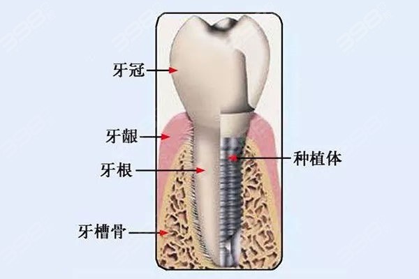 成都哪里种植牙便宜技术好？排查成都十大热门实惠的牙科医院