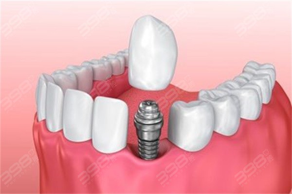 孝感种植牙价格表