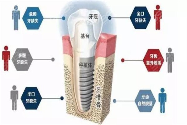 种植牙