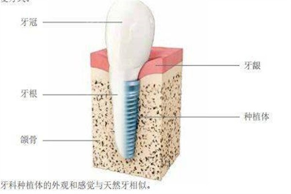 种植牙
