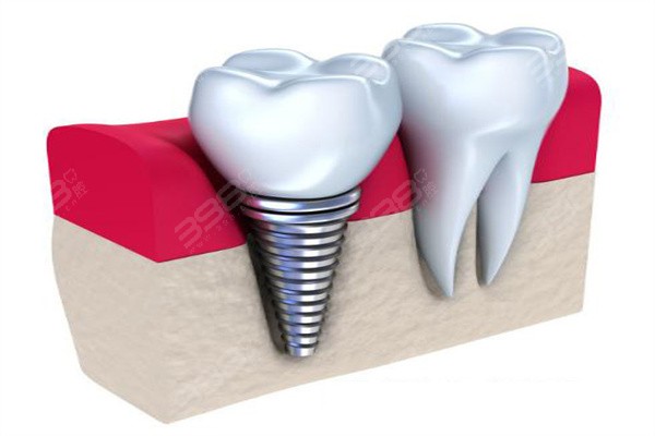 大连口腔医院种植牙价格