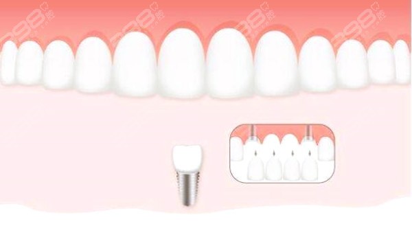多颗及全口种植牙价格