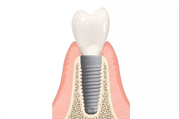 种植牙