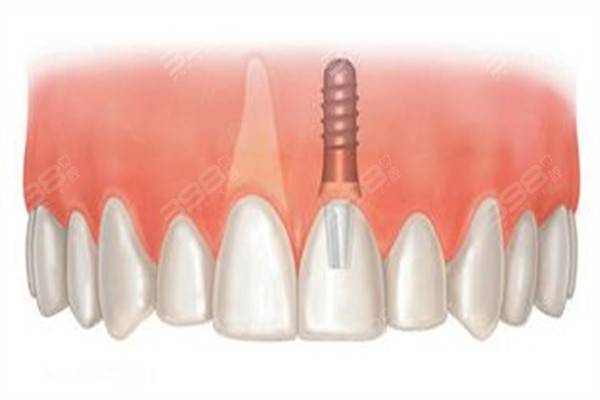 日照种植牙多少钱一颗？除价格外公布口腔医院排名及技术好的牙科