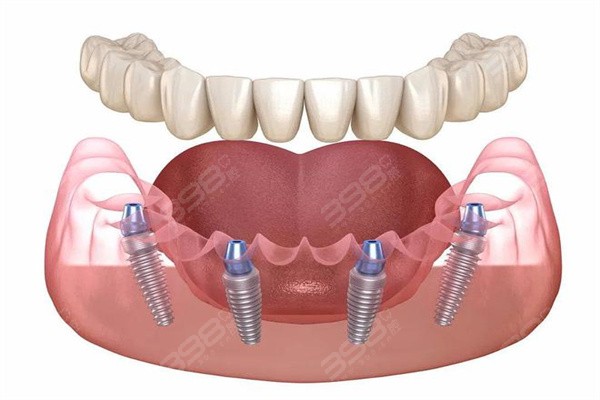 西安全口牙缺失种植多少钱？正规牙科做全口3w-10w元起技术放心