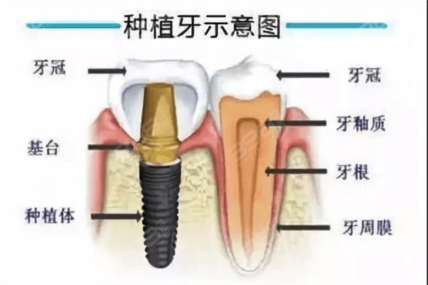 种植牙