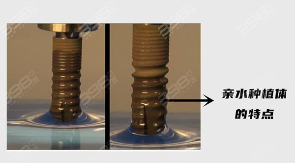 天津种植牙收费价格表
