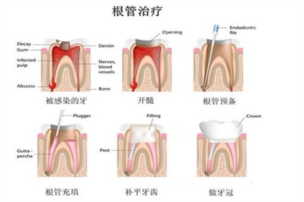 ‌影响牙齿根管治疗费用的核心变量‌