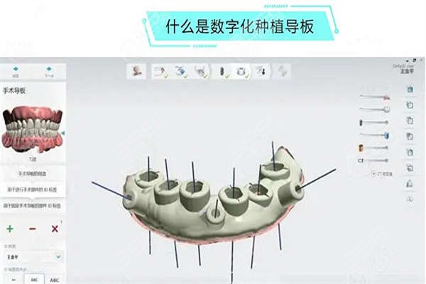 数字化种植牙