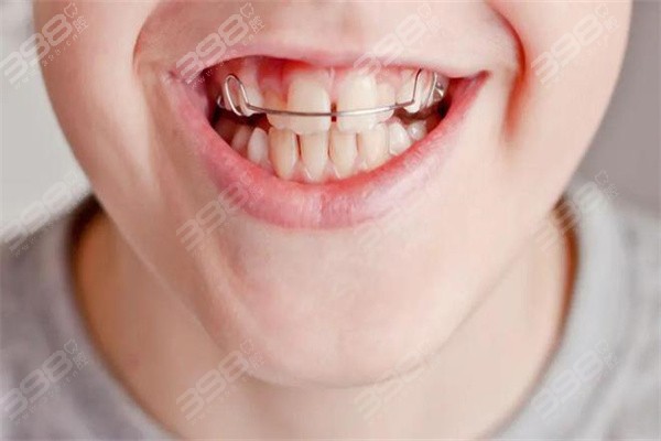 洛阳哪里矫正牙齿比较好？维乐/中诺/九龙等牙科都是性价比之选