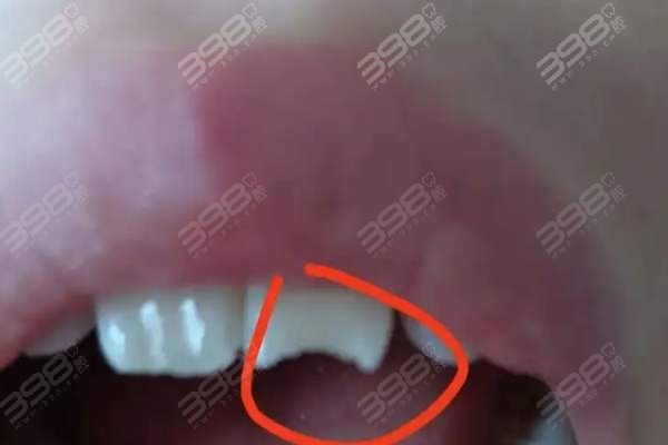牙齿莫名其妙碎了一小块别着急：到底怎么回事如何补救呀