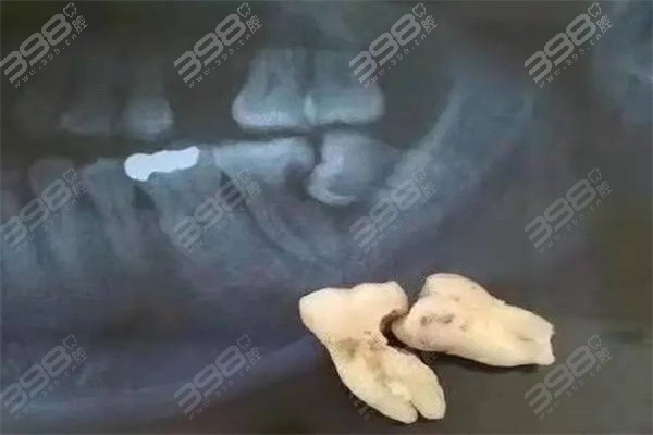 深圳拔智齿价格表