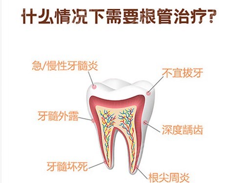 需要做根管治疗的情况