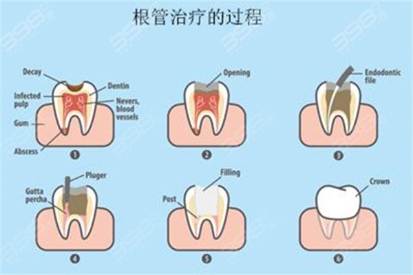 根管治疗的过程
