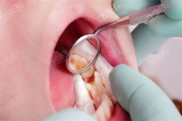 补牙一定要去大医院补牙才好吗？私人诊所怎么样？多方面对比……